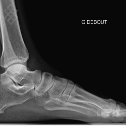 Radiographie Du Pied Bot
