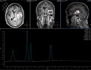 Spectroscopie Cérébrale