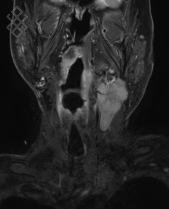 IRM des Tissus mous du Cou (ORL)