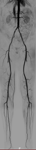 Angio-IRM des Membres inférieurs