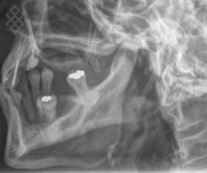 Radiographie des Articulations Temporo Mandibulaires (ATM)