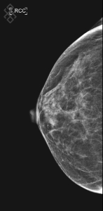 Mammographie bilatérale